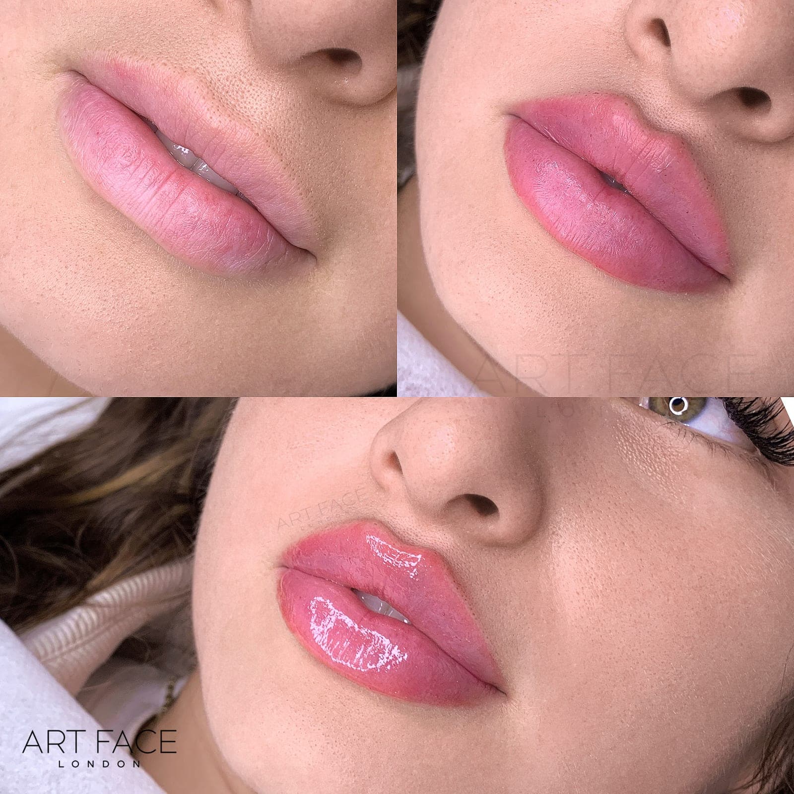 Lip enhancement before and after — result 1 at ART FACE Clinic, Pimlico, London