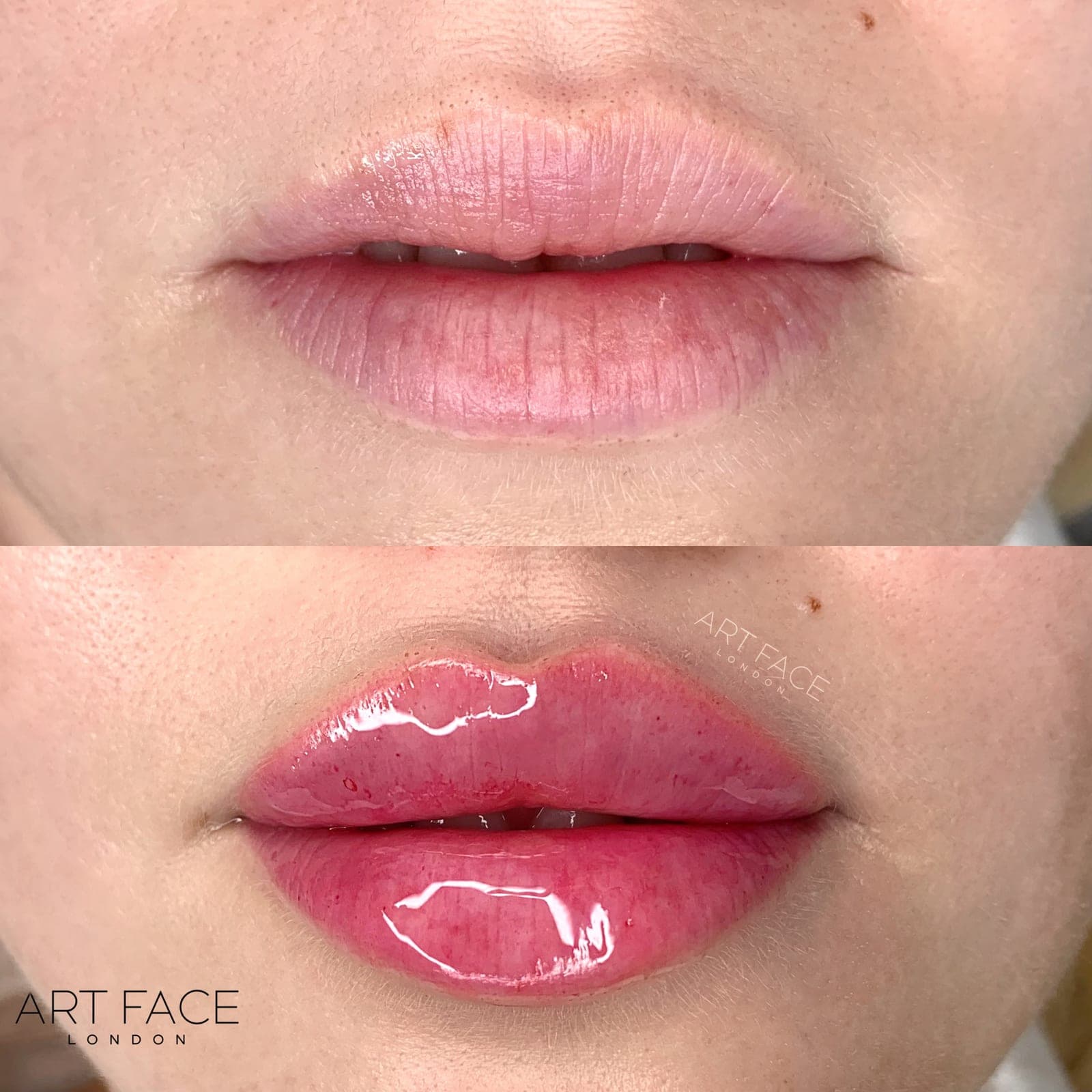 Lip enhancement before and after — result 2 at ART FACE Clinic, Pimlico, London