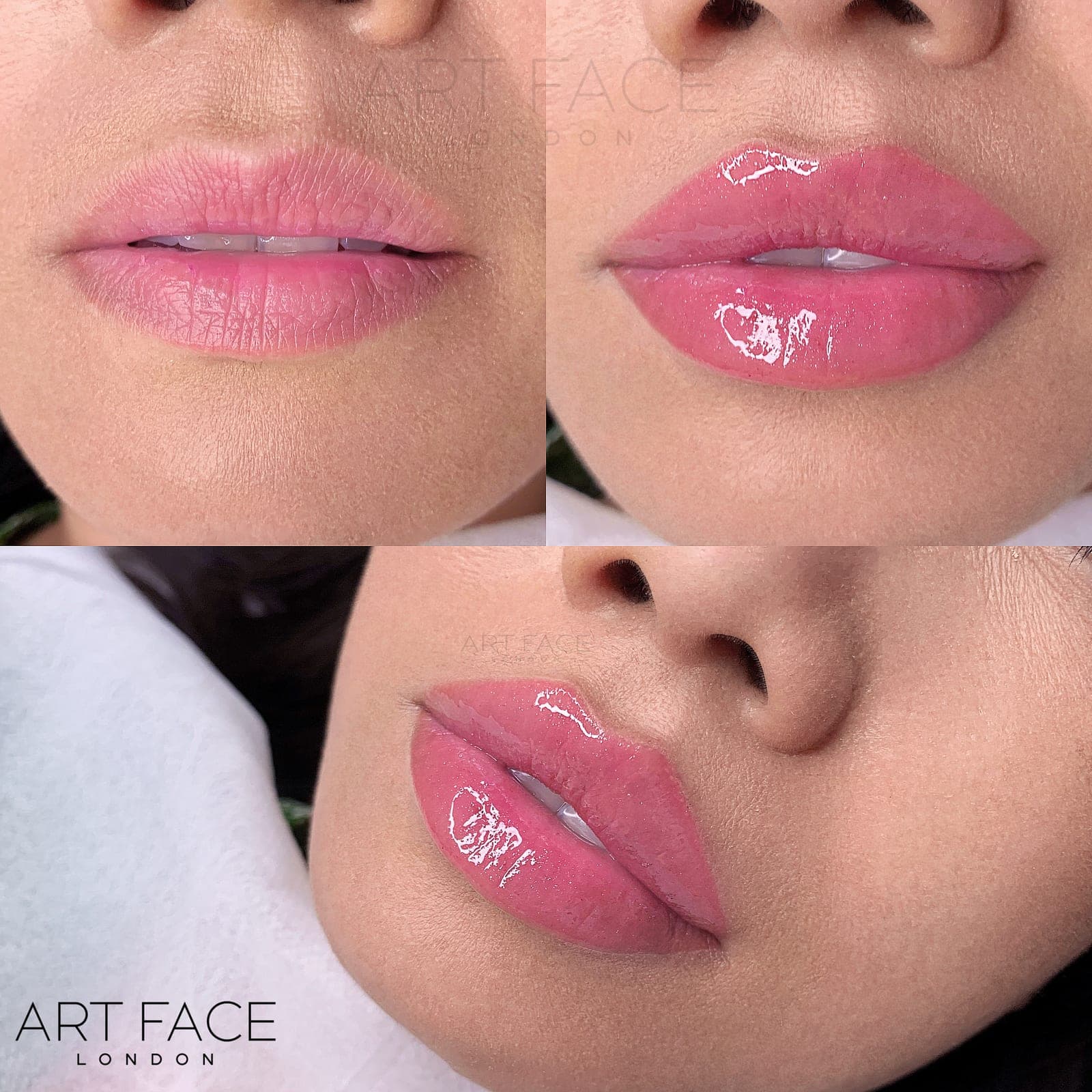 Lip enhancement before and after — result 3 at ART FACE Clinic, Pimlico, London