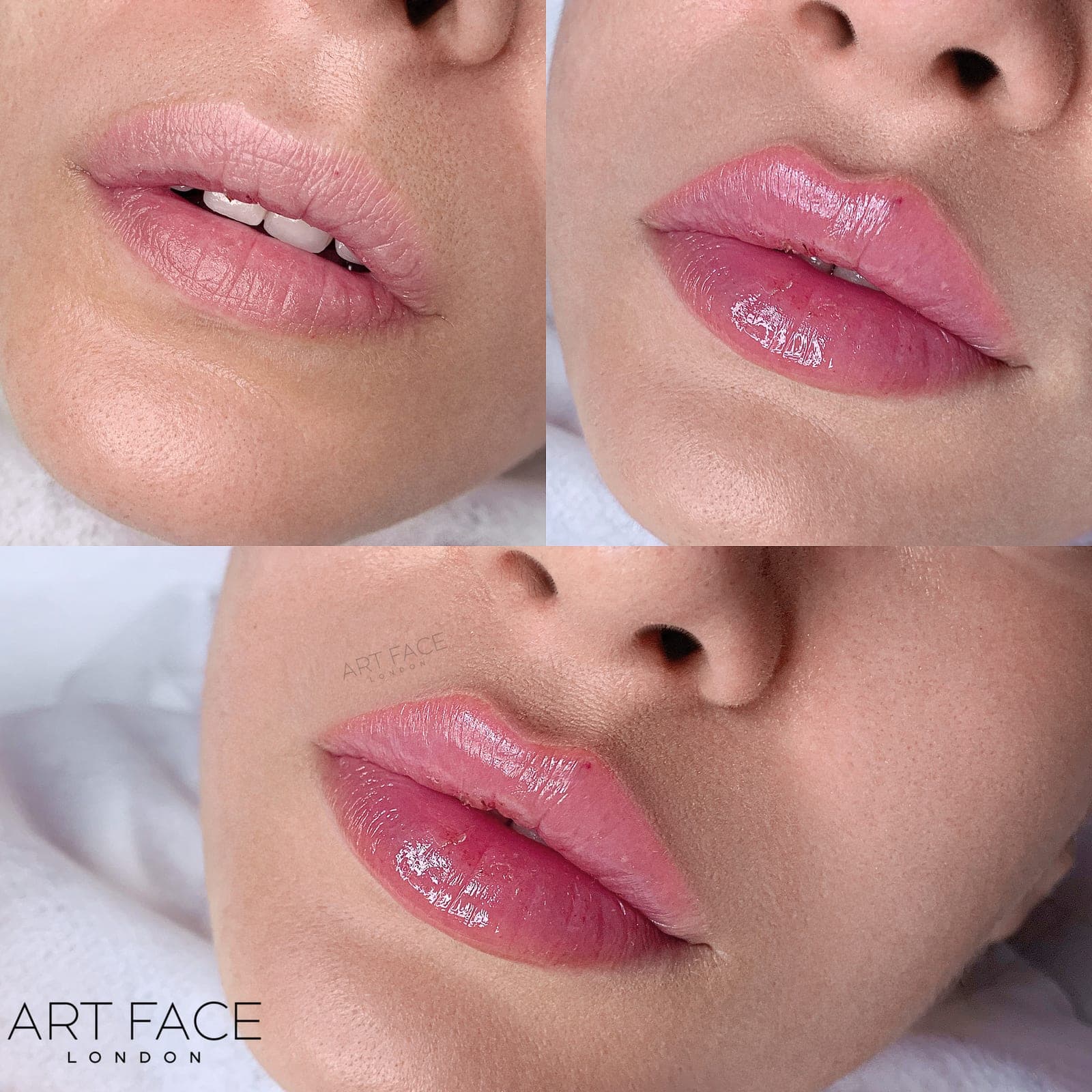 Lip enhancement before and after — result 4 at ART FACE Clinic, Pimlico, London