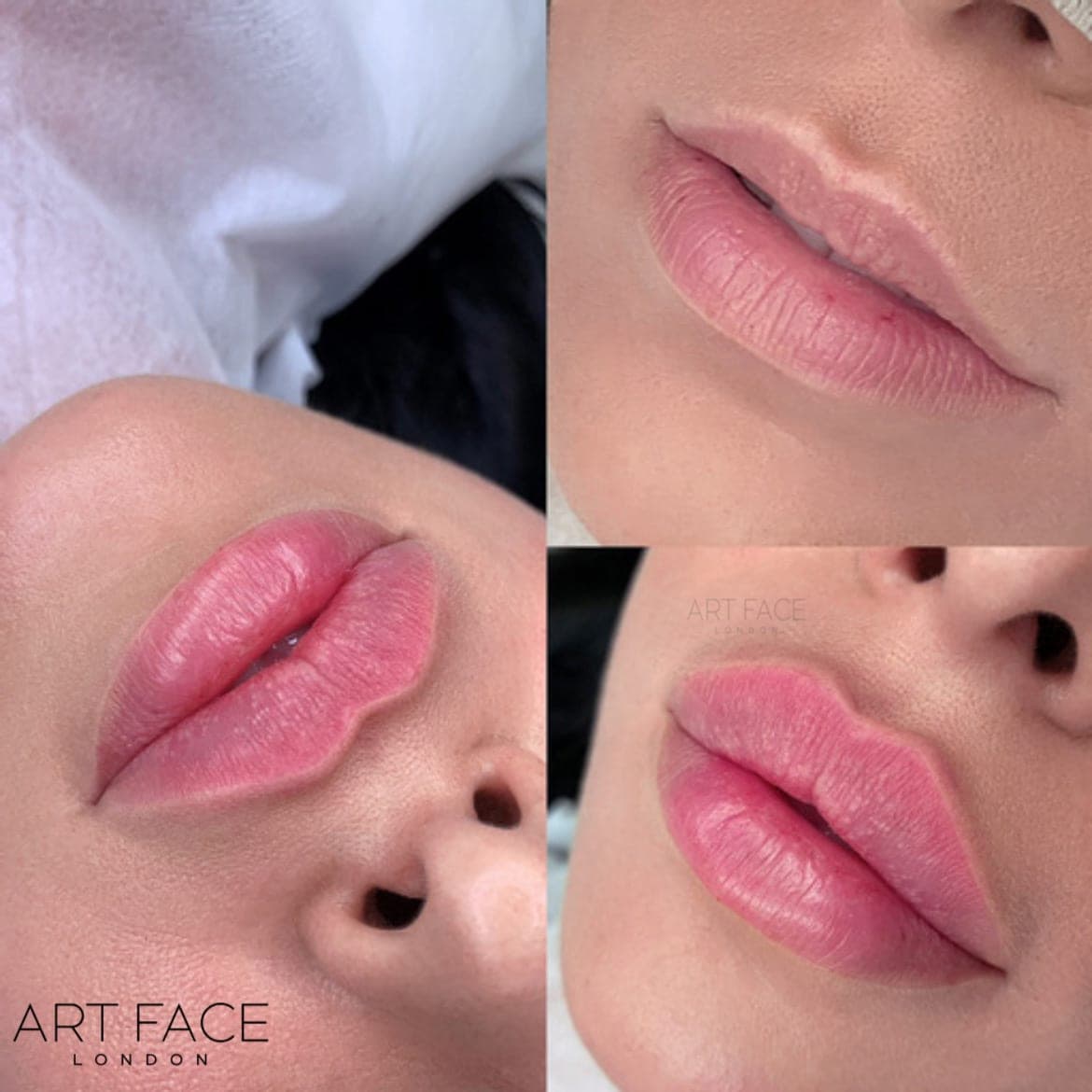 Lip enhancement before and after — result 5 at ART FACE Clinic, Pimlico, London