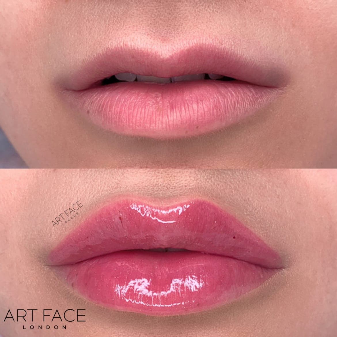 Lip enhancement before and after — result 6 at ART FACE Clinic, Pimlico, London
