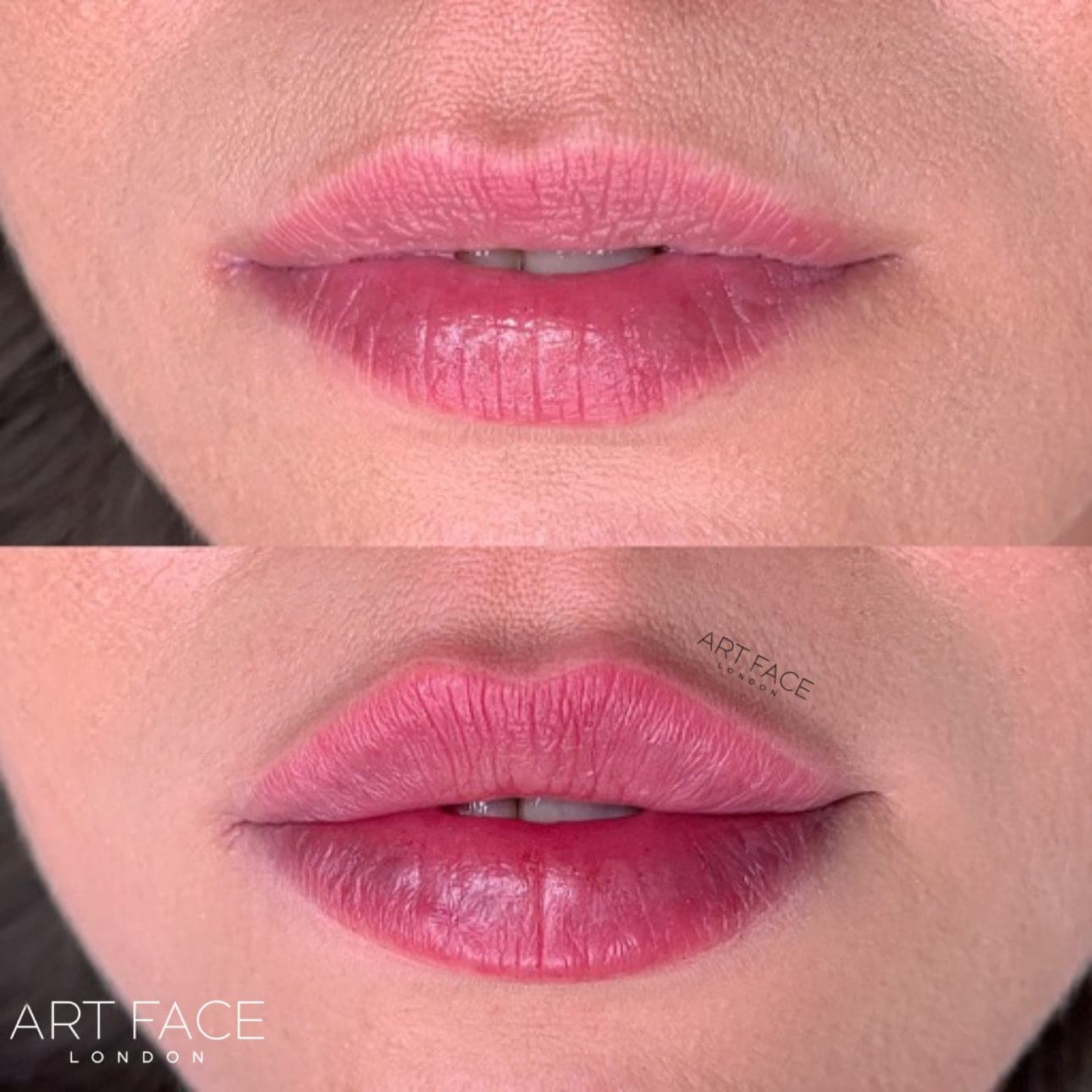 Lip enhancement before and after — result 7 at ART FACE Clinic, Pimlico, London