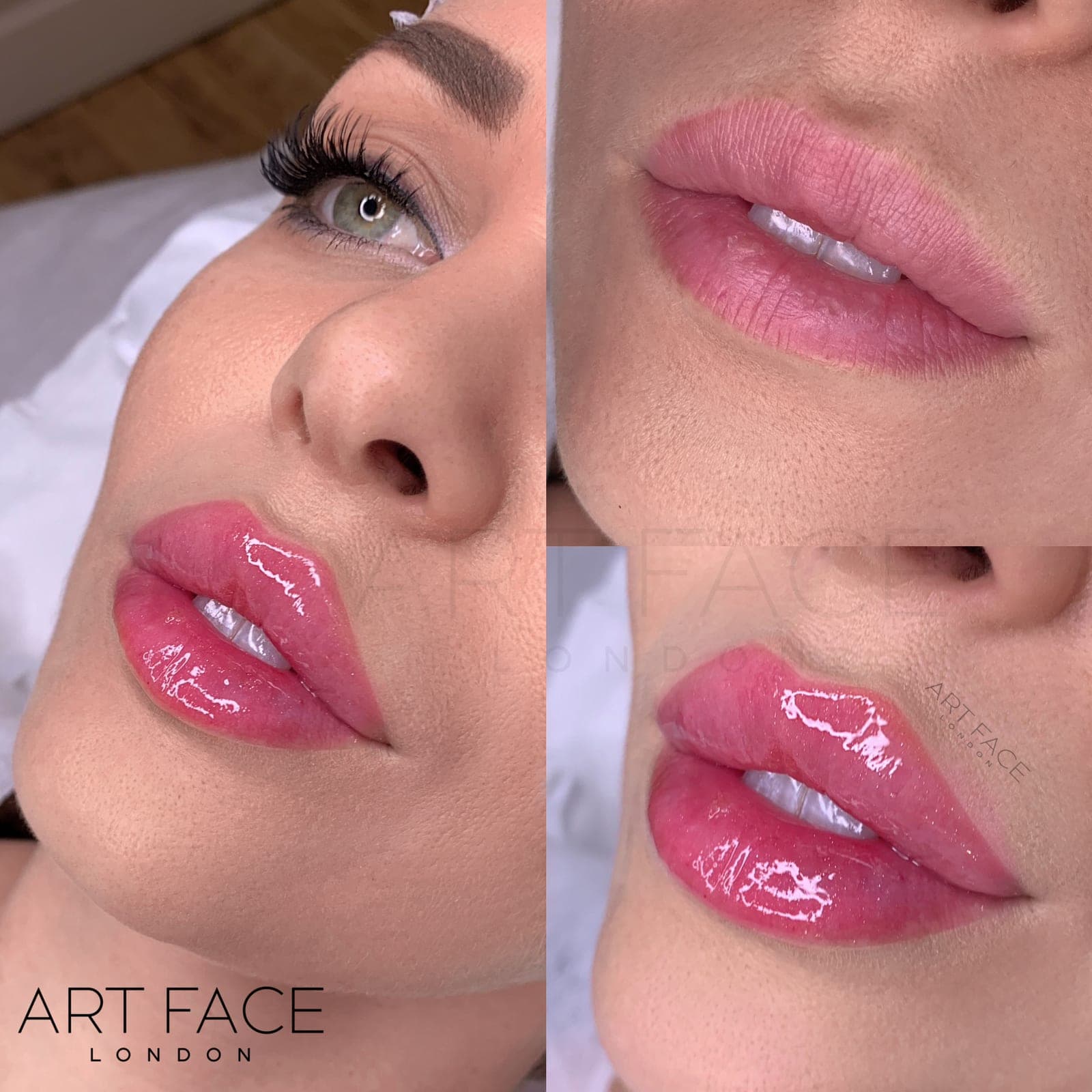 Lip enhancement before and after — result 8 at ART FACE Clinic, Pimlico, London