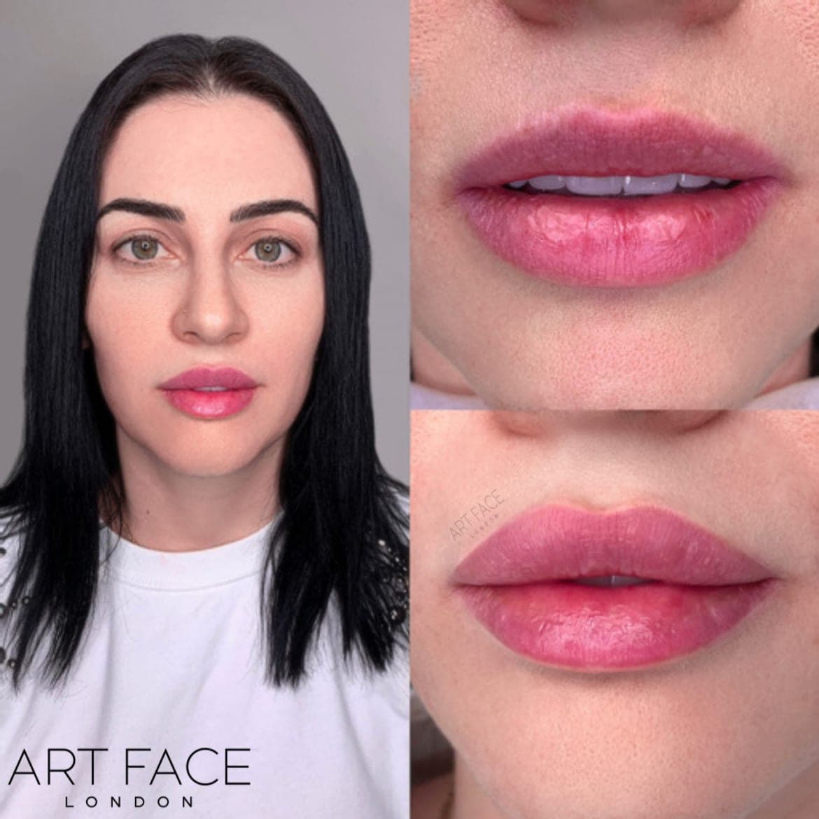 Lip enhancement before and after — result 9 at ART FACE Clinic, Pimlico, London