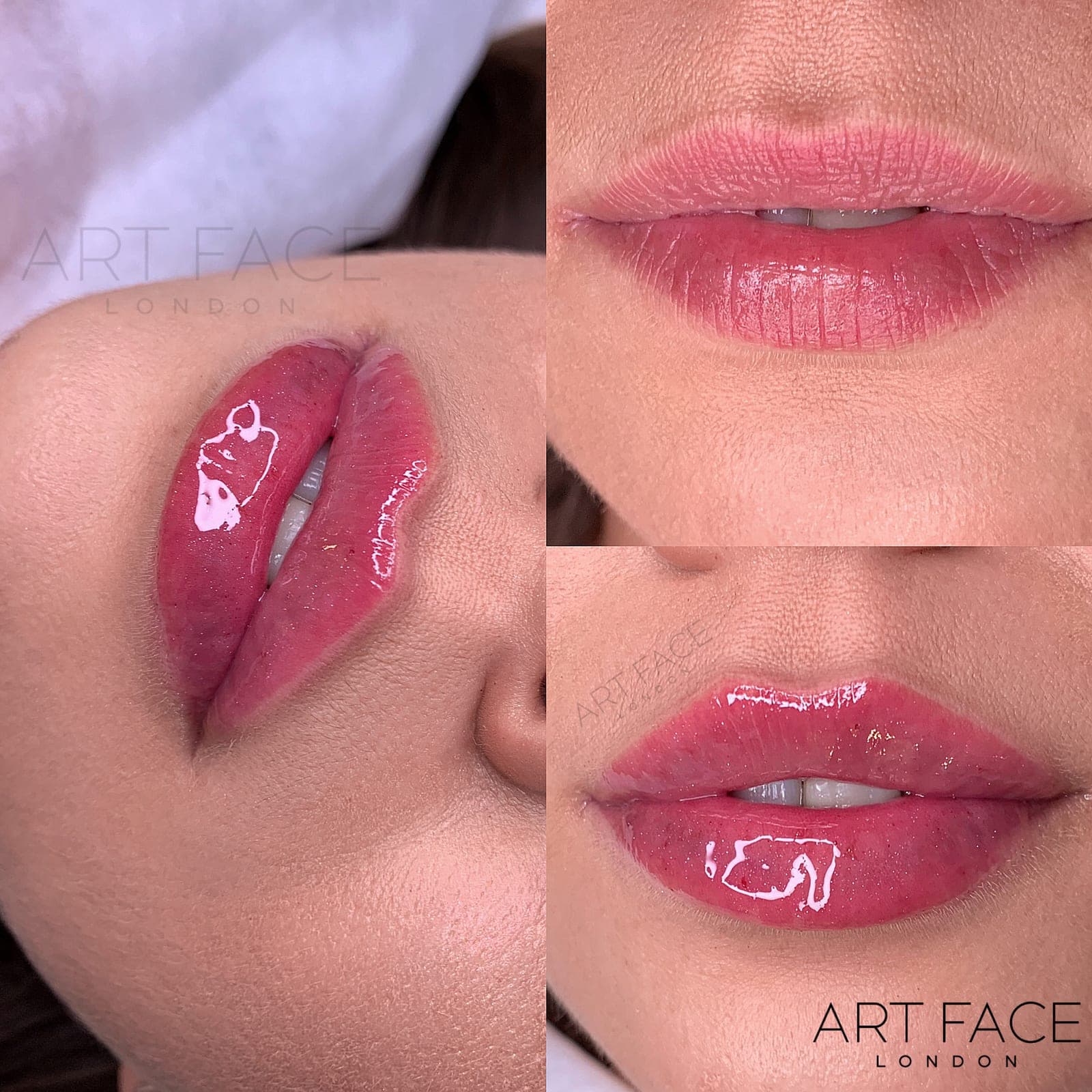 Lip enhancement before and after — result 10 at ART FACE Clinic, Pimlico, London