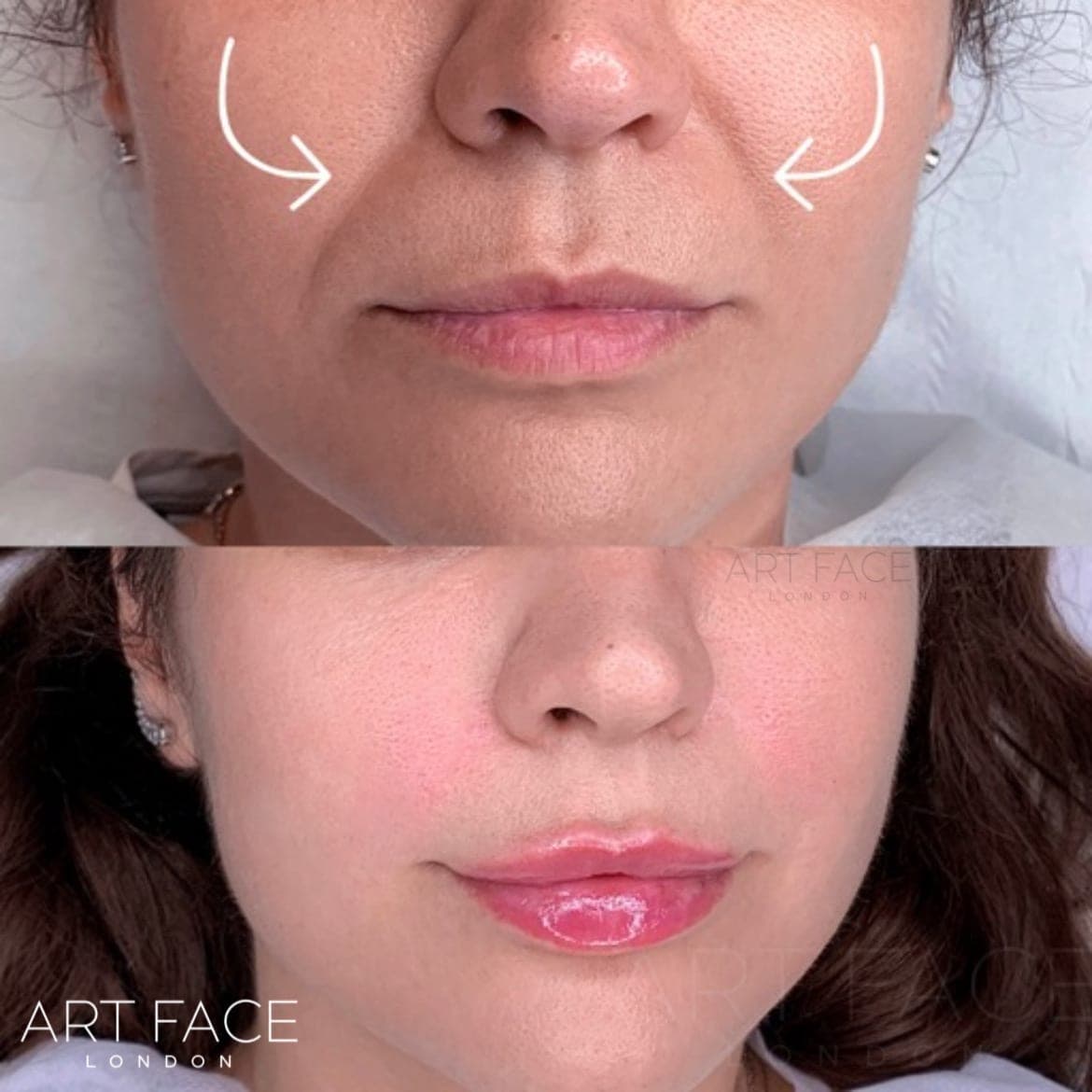 Nasolabial fold filler before and after — result 1 at ART FACE Clinic, Pimlico, London