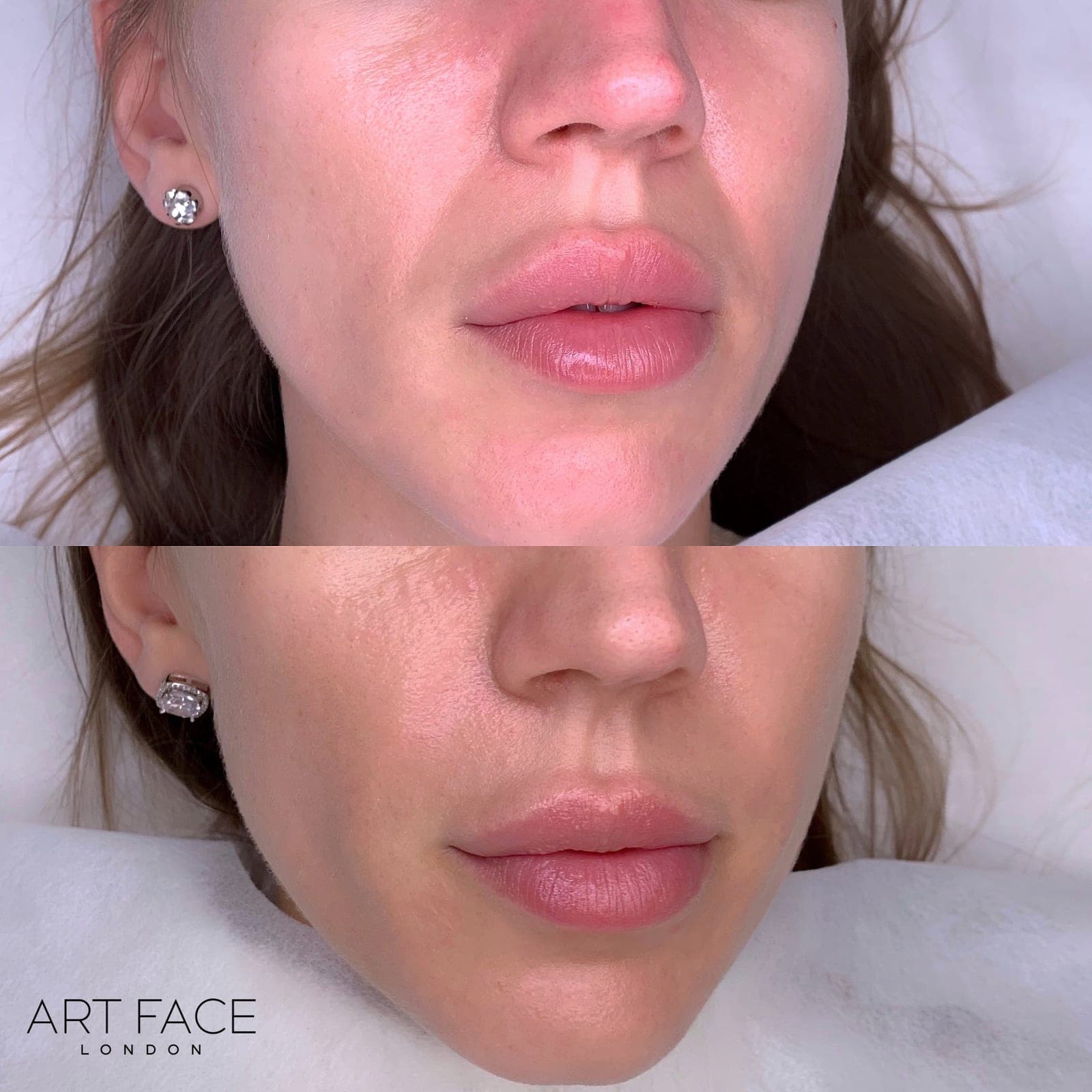 Nasolabial fold filler before and after — result 2 at ART FACE Clinic, Pimlico, London