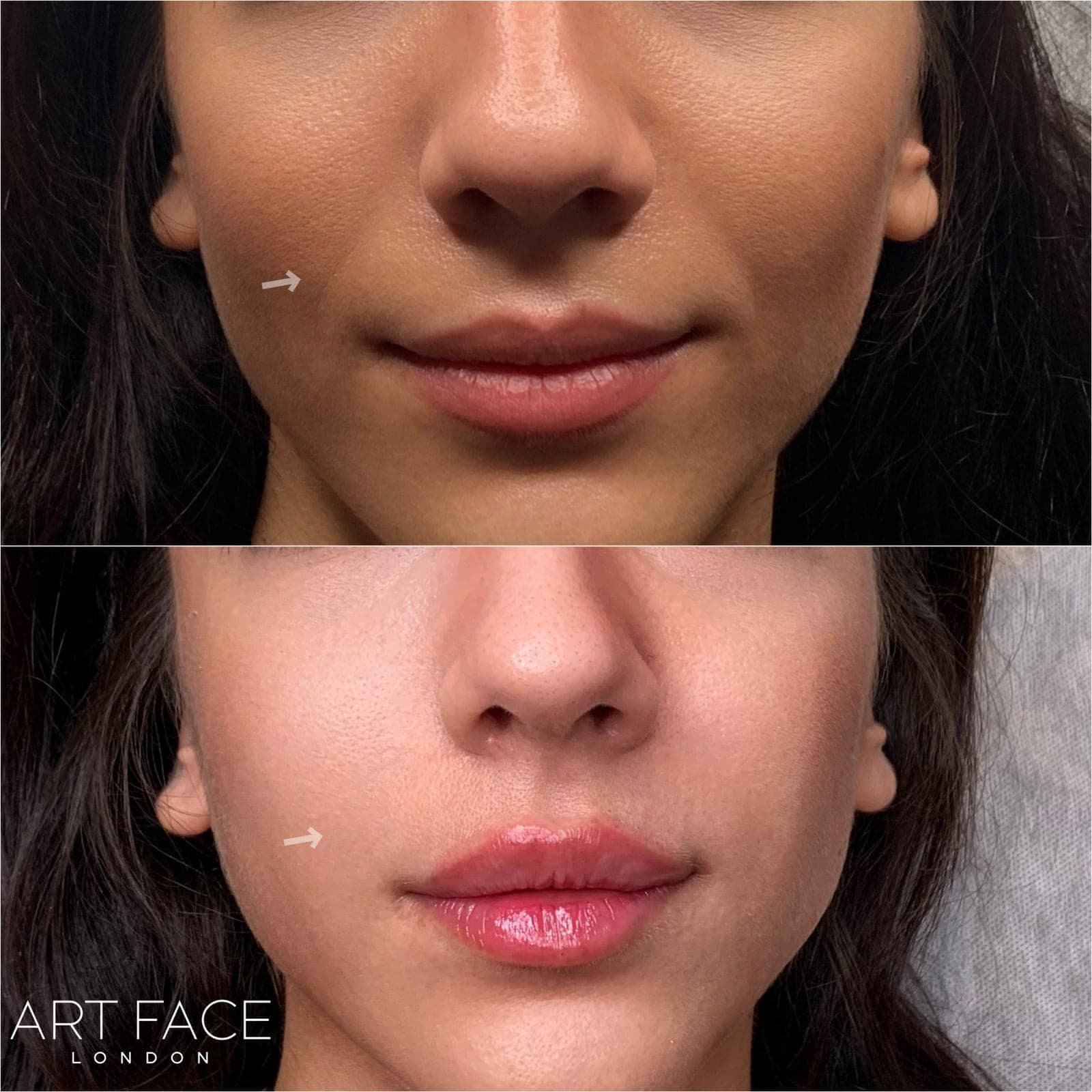 Nasolabial fold filler before and after — result 3 at ART FACE Clinic, Pimlico, London