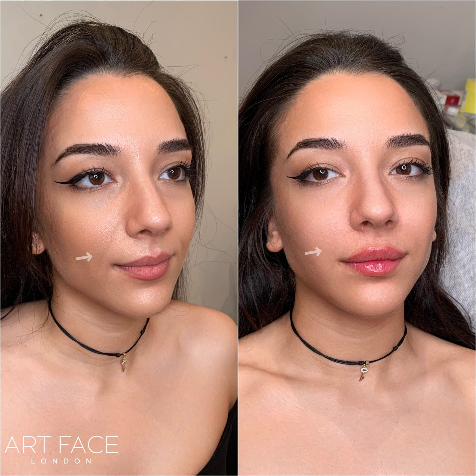 Nasolabial fold filler before and after — result 4 at ART FACE Clinic, Pimlico, London