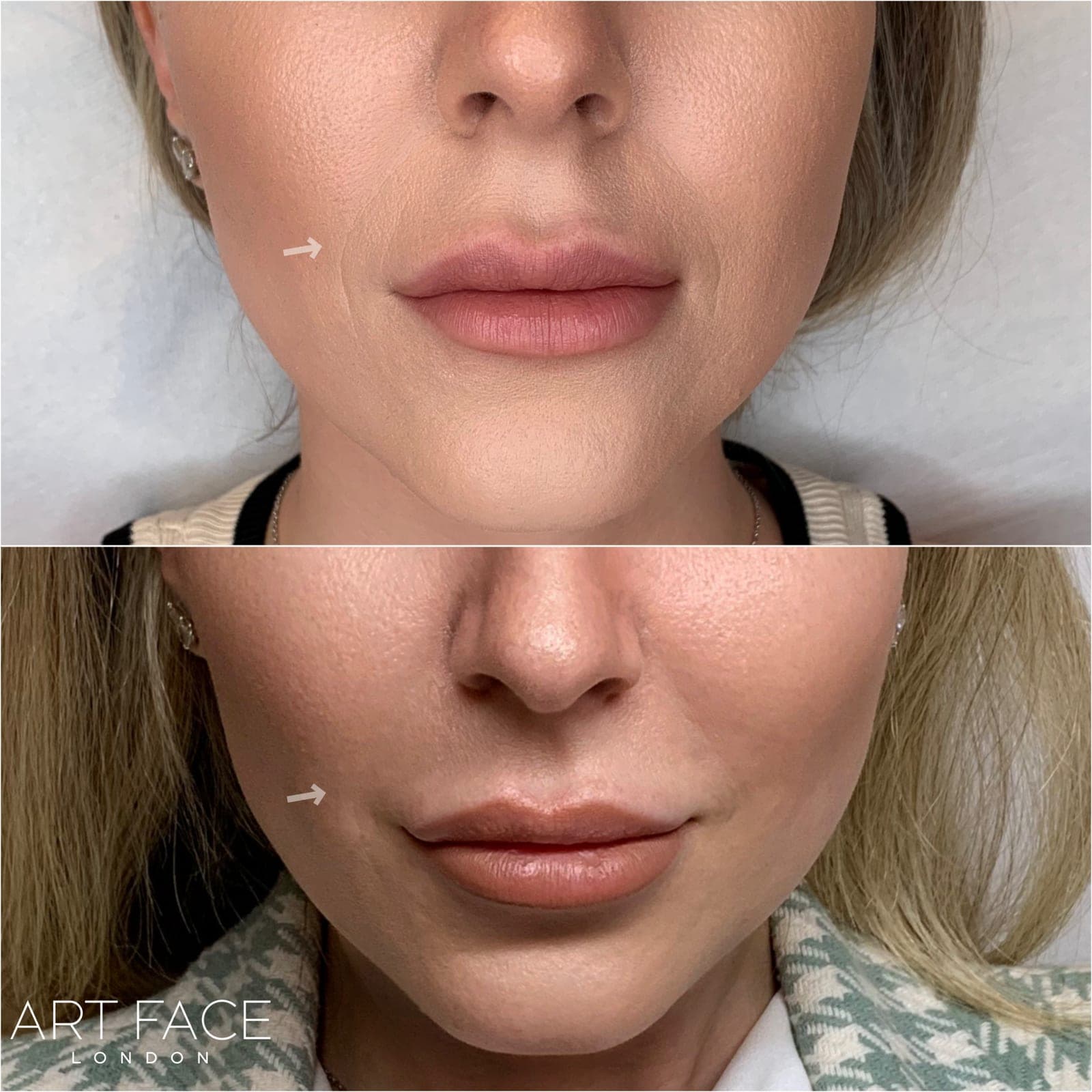 Nasolabial fold filler before and after — result 5 at ART FACE Clinic, Pimlico, London