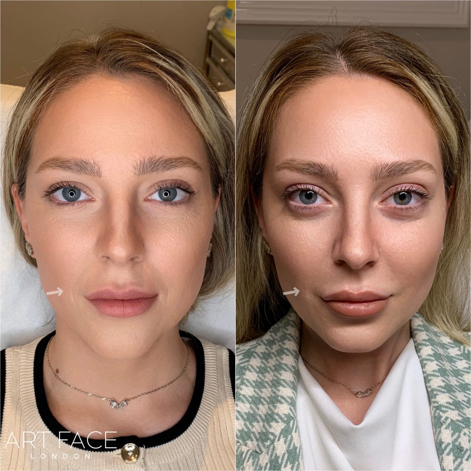 Nasolabial fold filler before and after — result 6 at ART FACE Clinic, Pimlico, London