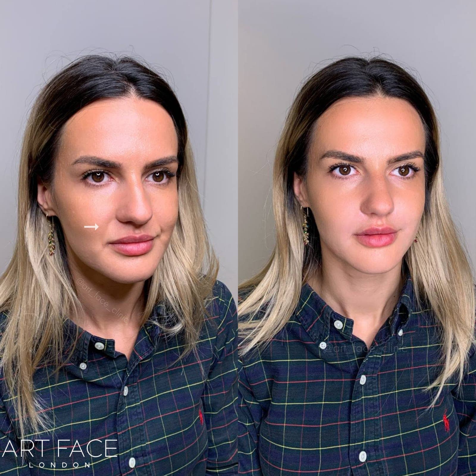 Nasolabial fold filler before and after — result 7 at ART FACE Clinic, Pimlico, London
