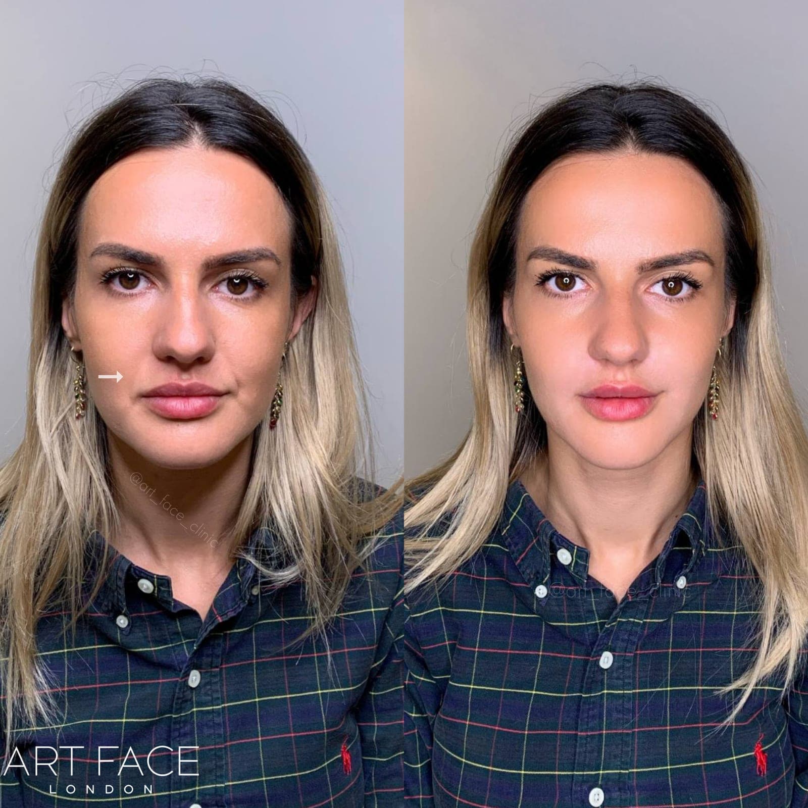 Nasolabial fold filler before and after — result 8 at ART FACE Clinic, Pimlico, London