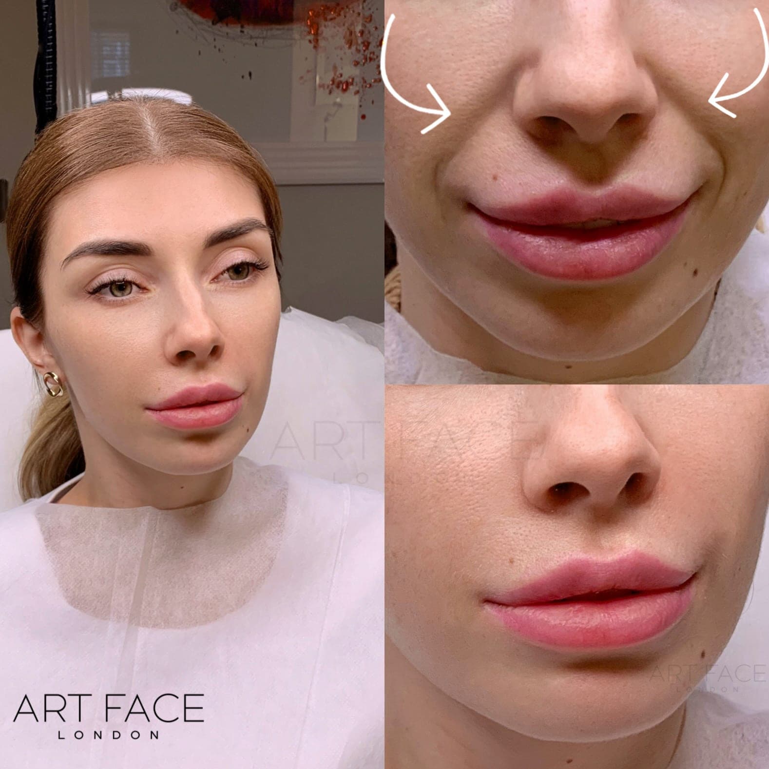Nasolabial fold filler before and after — result 9 at ART FACE Clinic, Pimlico, London
