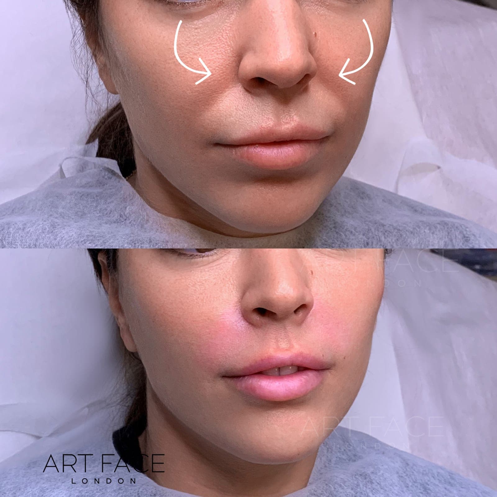 Nasolabial fold filler before and after — result 10 at ART FACE Clinic, Pimlico, London