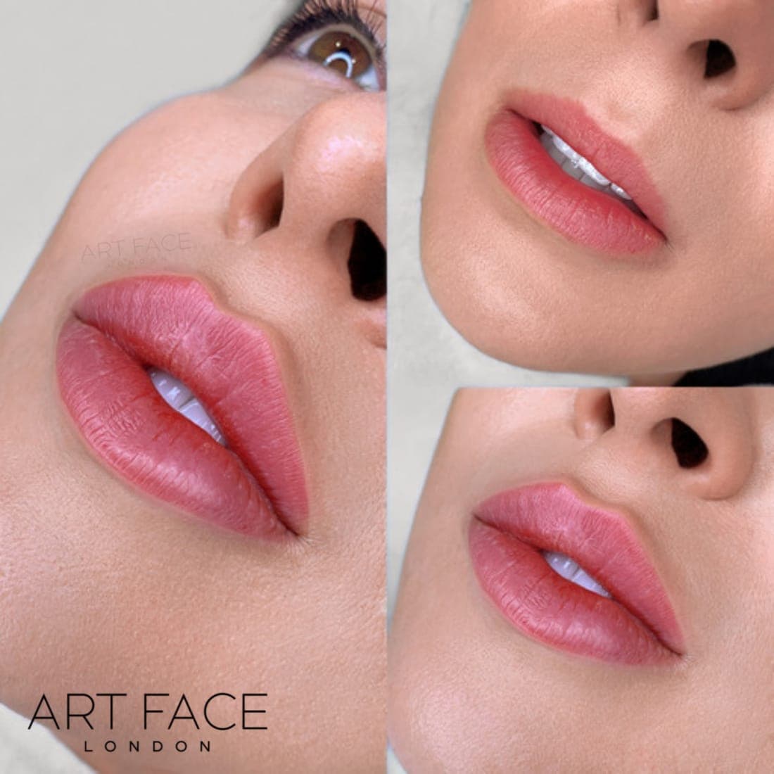 Lip Definition & Balance — lip filler result at ART FACE Clinic