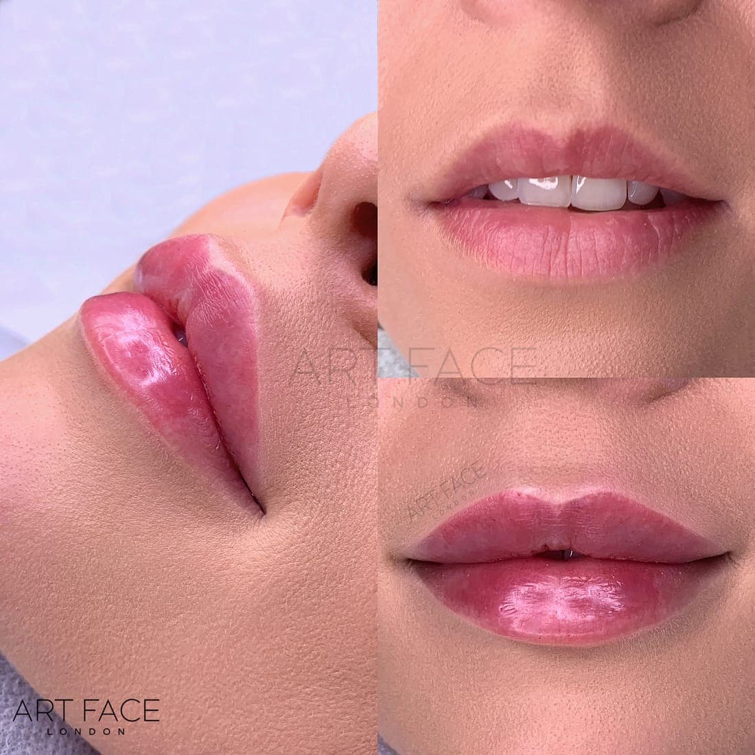 Natural Lips — lip filler result at ART FACE Clinic