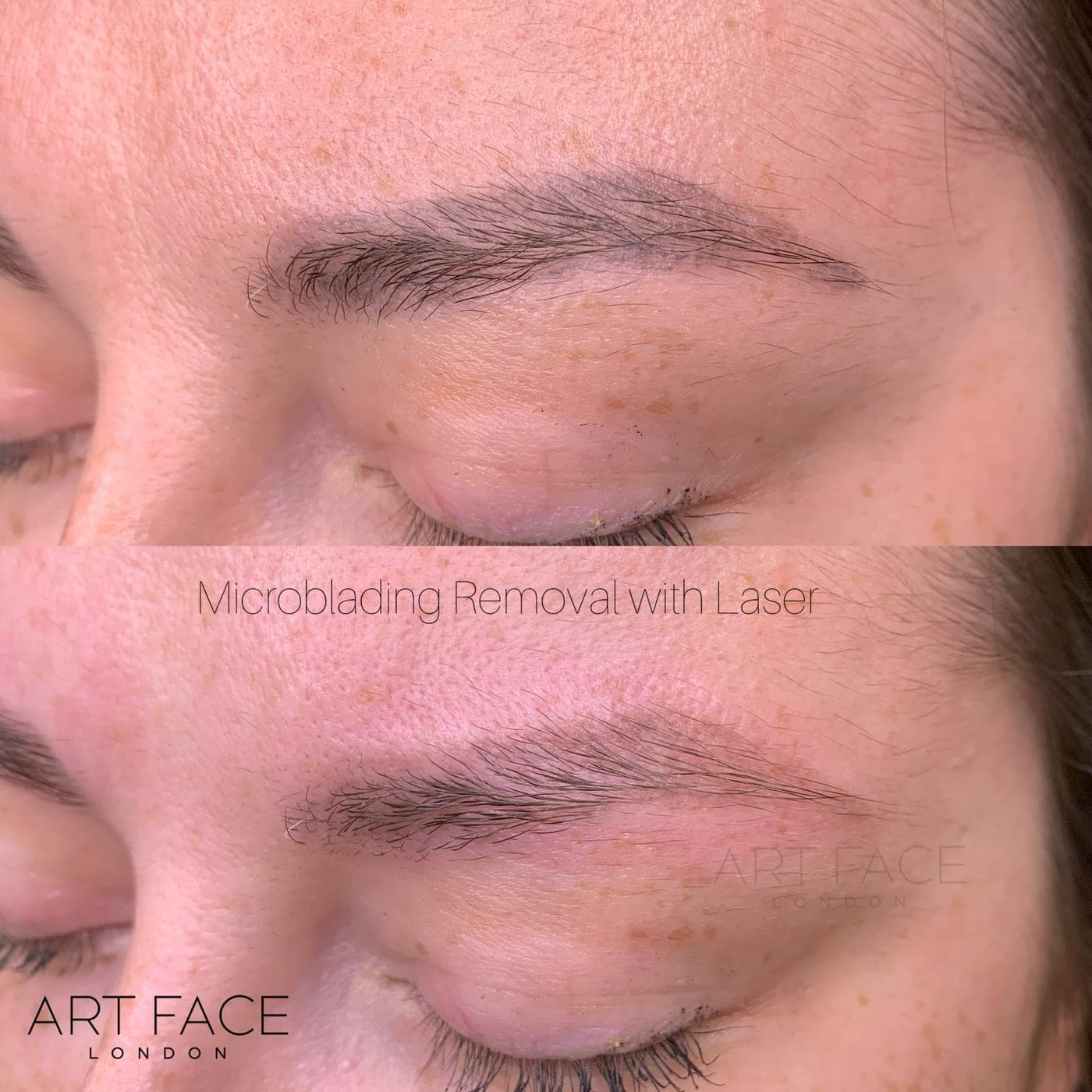 Microblading removal with laser — brow before (top) and after (bottom) at ART FACE Clinic