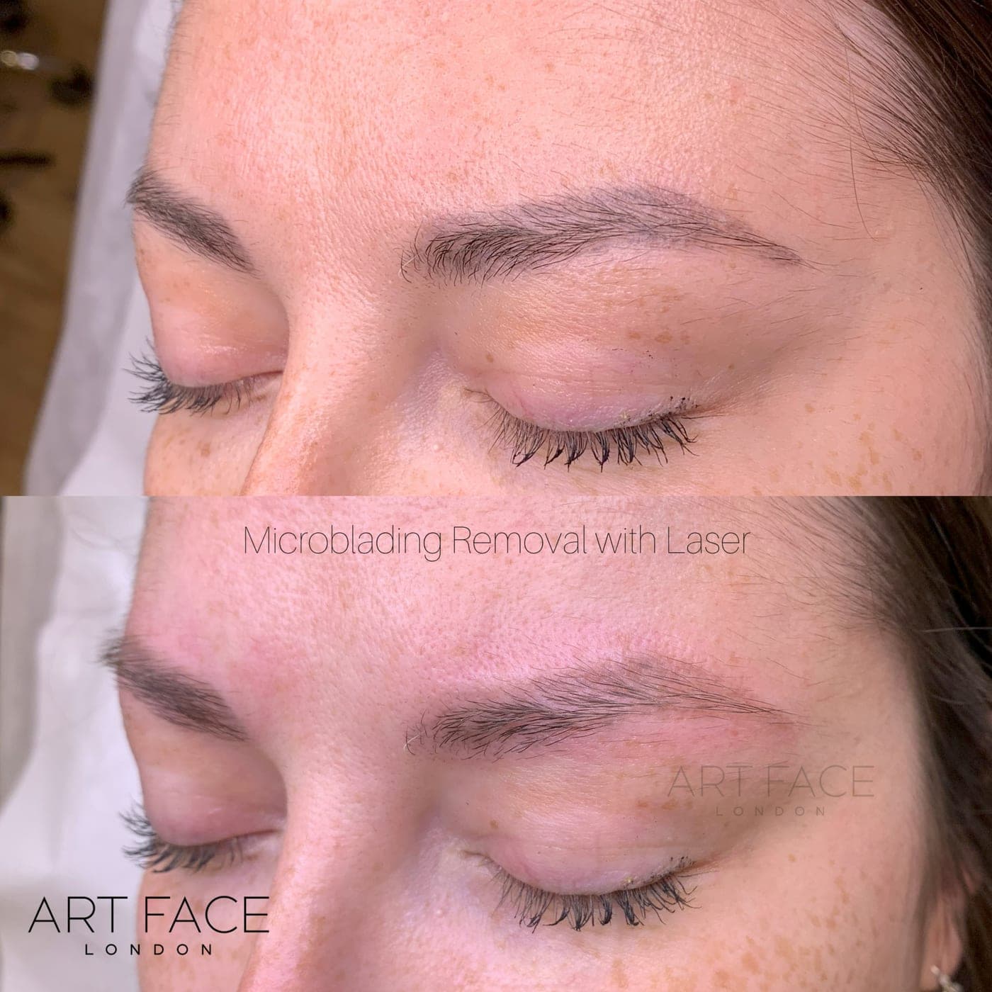 Microblading removal with laser — second view of the same brow, before (top) and after (bottom)