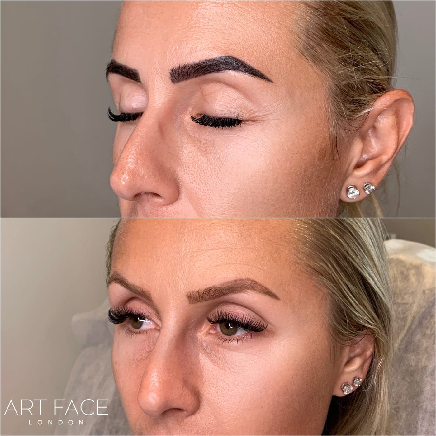 Powder brow removal — brows before (top) and after (bottom) laser treatment at ART FACE Clinic