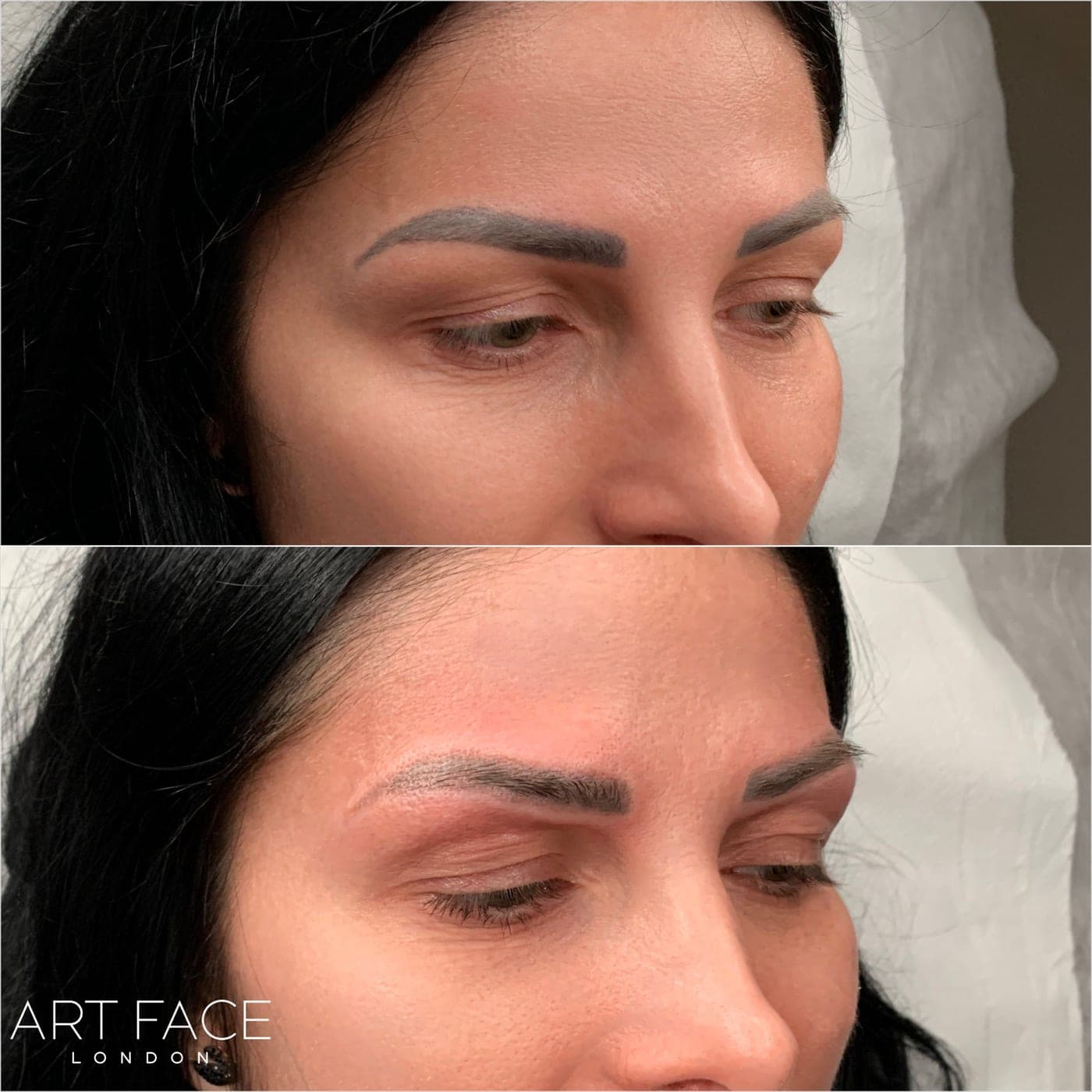 Powder brow removal — dark brow pigment before (top) and after (bottom) laser treatment at ART FACE Clinic