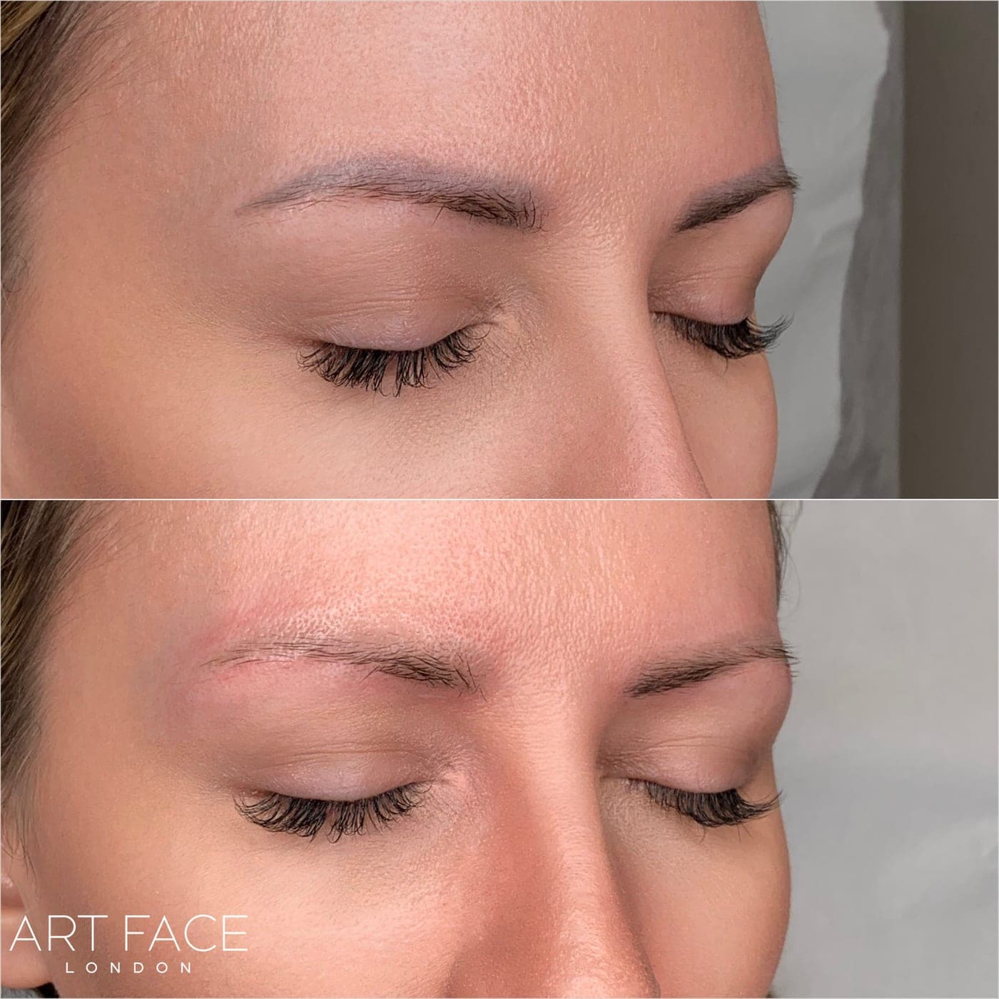 Eyebrow pigment removal before and after — result 5 at ART FACE Clinic, Pimlico, London