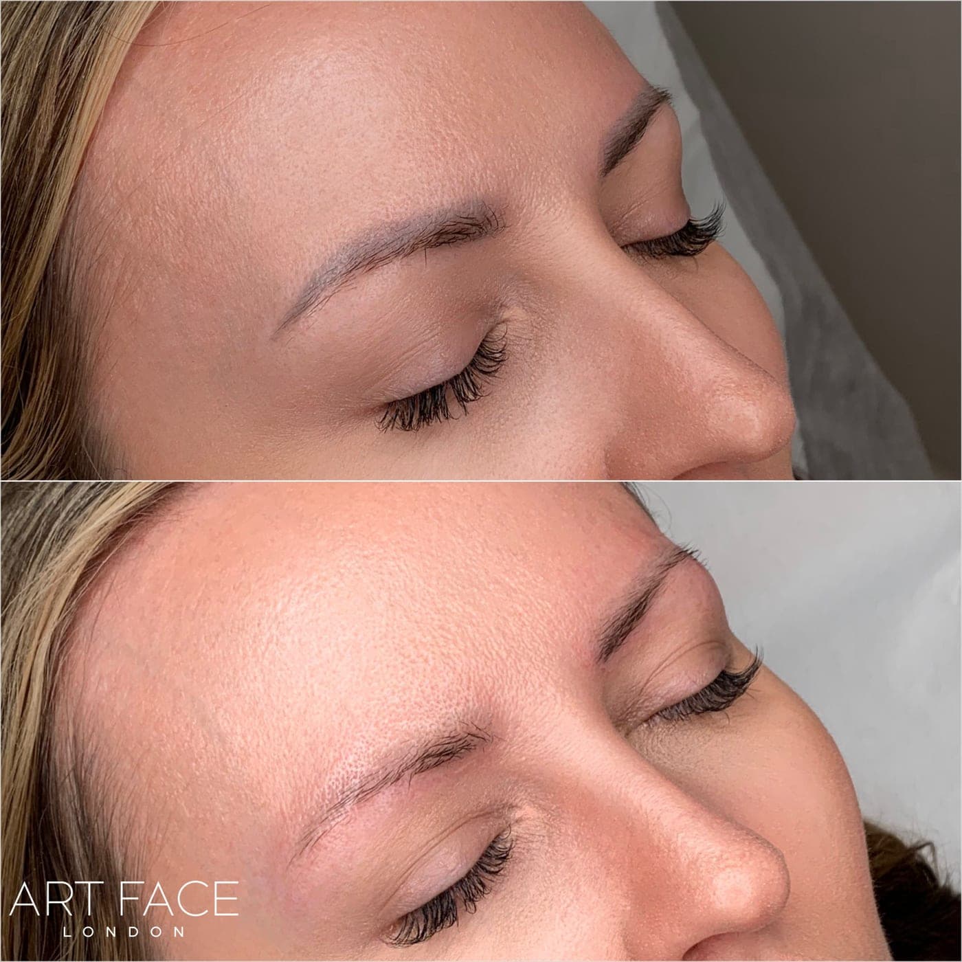 PMU / powder brow removal — angled view of the same brows before (top) and after (bottom)