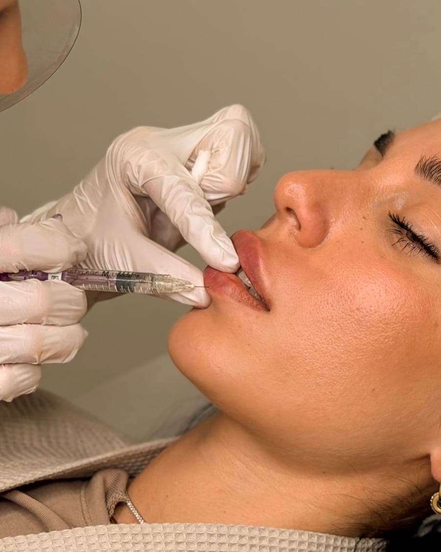 Lip filler treatment in progress at ART FACE London