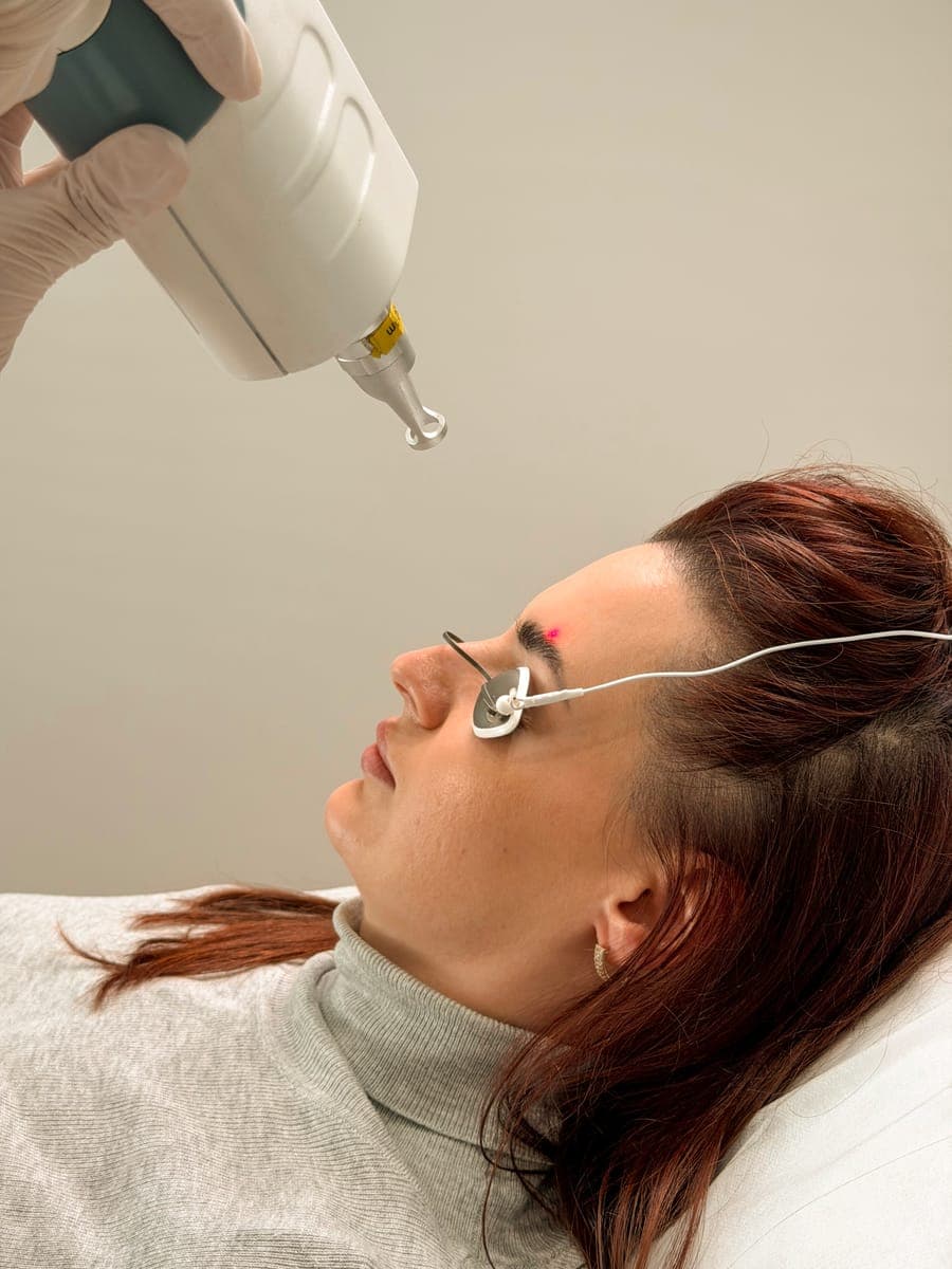 Laser tattoo removal handpiece and eye shields at ART FACE London